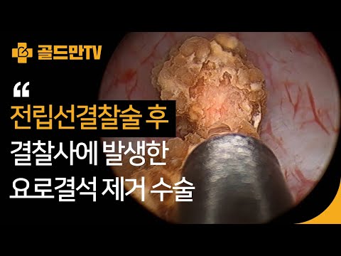 전립선결찰술 후 요로결석 제거 수술
