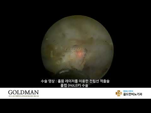 홀뮴 레이저 이용 전립선 적출술 (HOLEP), 골드만비뇨기과