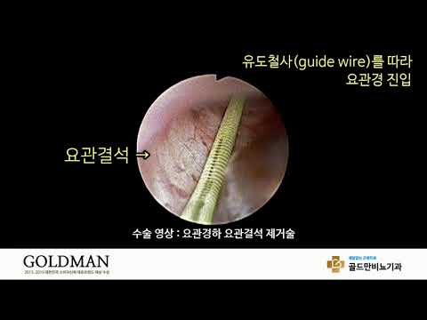 요관경하 요관결석 제거술 수술 영상