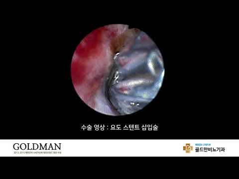 요도 스텐트 삽입술 수술 영상골드만비뇨기과 요도 스텐트 삽입술