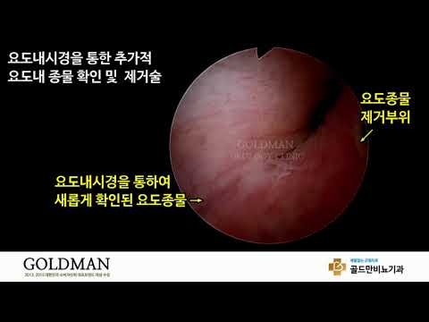 요도내시경, 요도종물 확인 및 제거새롭게 확인된 요도종물 (골드만비뇨기과)요도종물 제거 부위 (골드만비뇨기과)