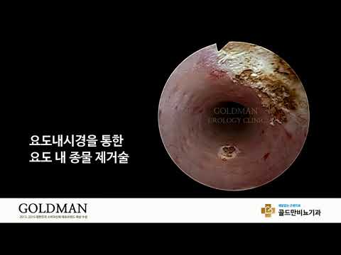 요도내시경 종물 제거술, 골드만비뇨기과