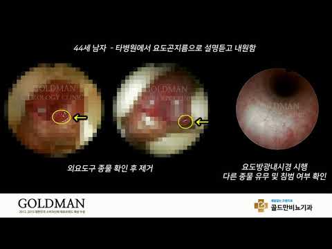 요도곤지름으로 내원한 44세 남자, 외요도구 종물 제거 및 내시경 시행.