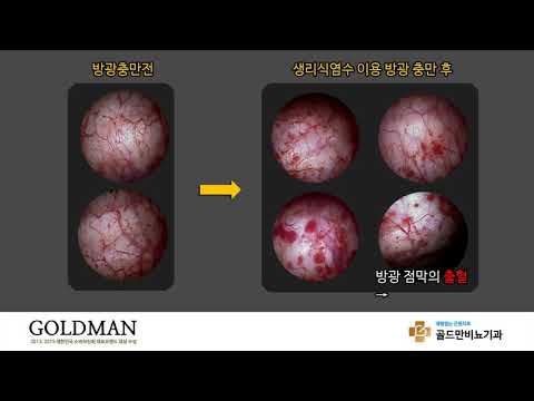 생리식염수 이용 방광 충만 후 방광 점막 출혈.