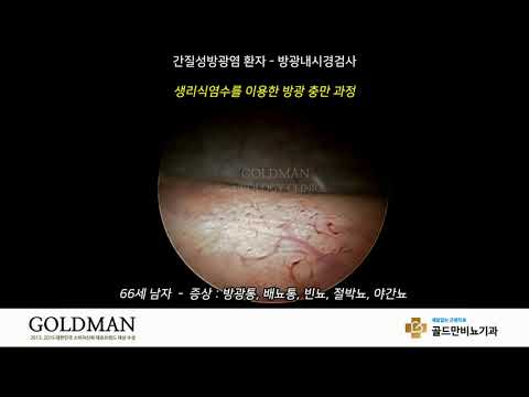 간질성방광염 환자 방광내시경 검사생리식염수 이용 방광 충만 과정방광통, 배뇨통, 빈뇨 겪는 66세 남성골드만비뇨기과