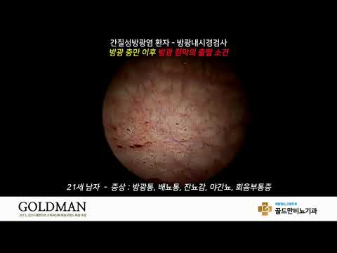 방광내시경 검사 중 출혈 보이는 간질성방광염 환자