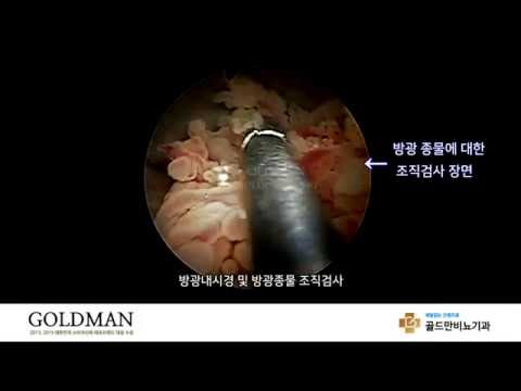 방광내시경 및 조직검사: 방광 종물 검사 장면 (골드만비뇨기과)