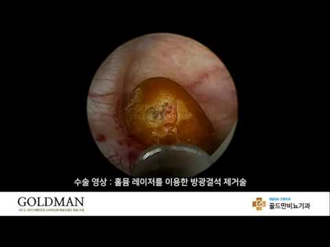 홀뮴 레이저 방광결석 제거술 영상골드만비뇨기과 방광결석 제거 수술