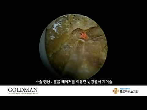 홀뮴 레이저 방광결석 제거술 영상. 골드만비뇨기과.