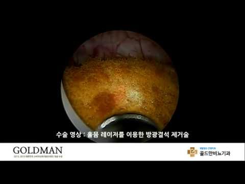 홀뮴 레이저 방광결석 제거술 영상골드만비뇨기과 방광결석 제거 수술
