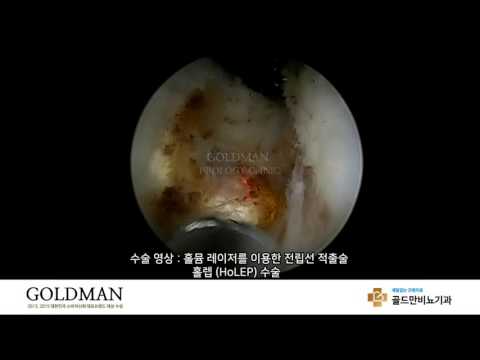 홀뮴 레이저 이용 전립선 적출술, 홀렙 수술 영상