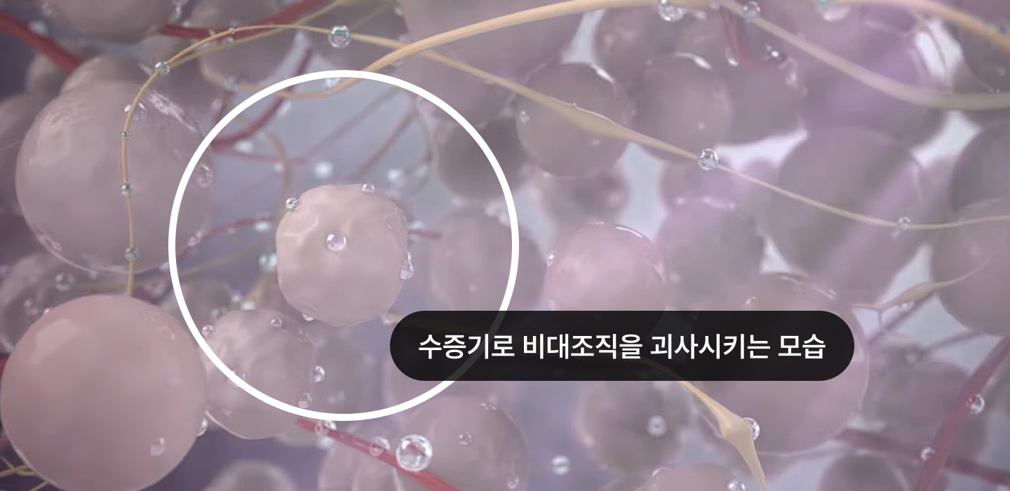 수증기로 비대조적을 괴사되는 모습