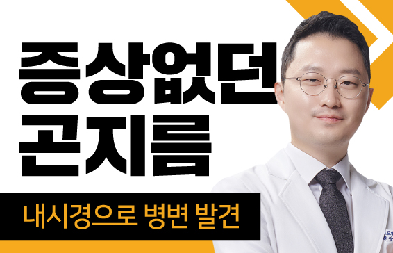 증상 없던 곤지름, 내시경으로 병변 발견.